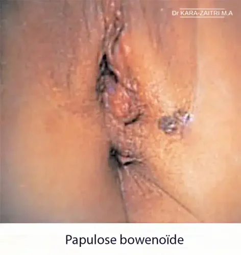 Papulose bowenoide 2