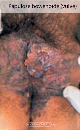 Lésions rouges de la vulve - Papulose bowénoïde de la vulve — lésion HPV-induite