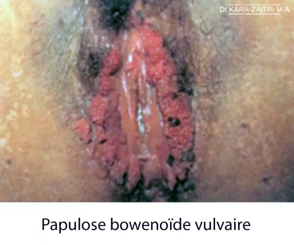 Lésions rouges de la vulve - Papulose bowénoïde vulvaire — lésion précancéreuse de la vulve