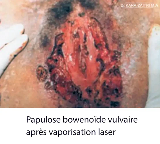 Lésions rouges de la vulve