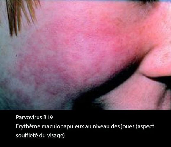 Parvovirus_erytheme 2