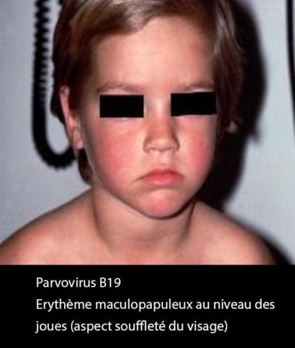 Parvovirus_erytheme
