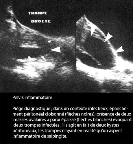 Pelvis inflammatoire