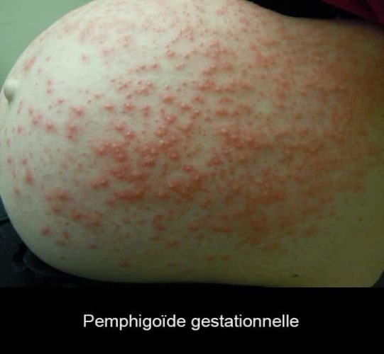 Pemphigoïde gestationnelle