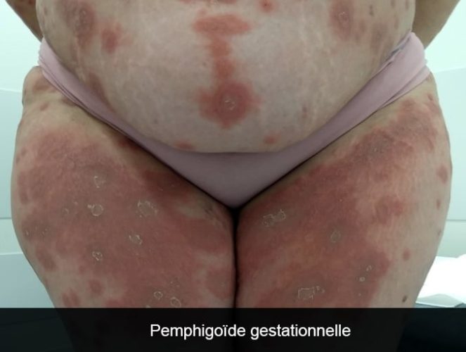 Pemphigoïde gestationnelle — lésions cutanées bulleuses 12