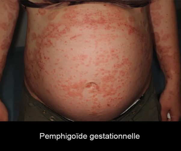 pemphigoïde gestationnelle