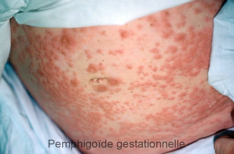 Pemphigoïde gestationnelle 3