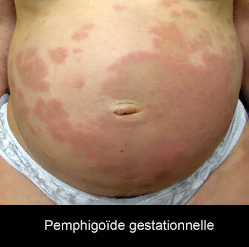 Pemphigoide-gestationnelle-5