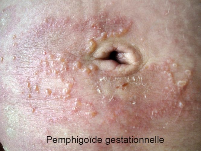 Pemphigoïde gestationnelle 7