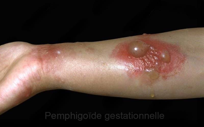 Pemphigoïde gestationnelle 8