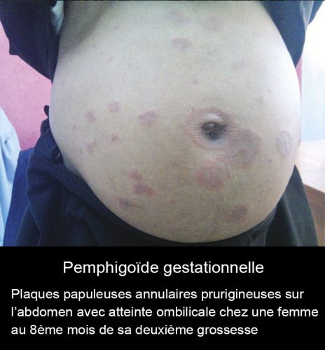 Pemphigoïde gestationnelle