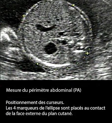Perimetre abdominal 3