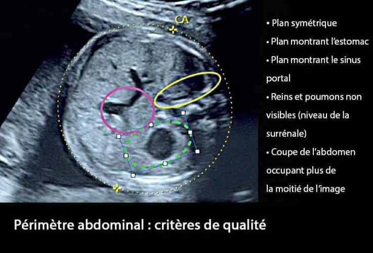 Perimetre abdominal 4