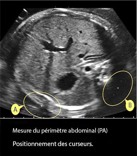 Perimetre abdominal 5