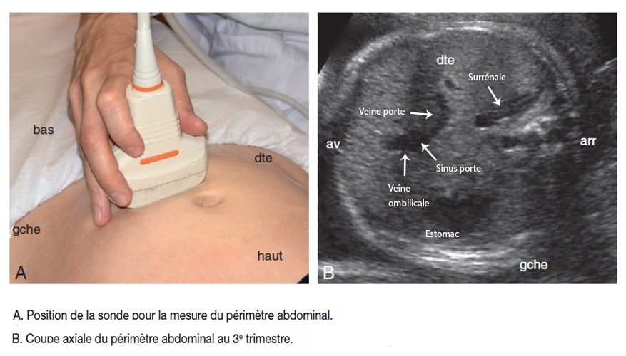 Perimetre abdominal