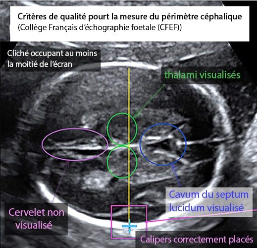 Perimetre cephalique