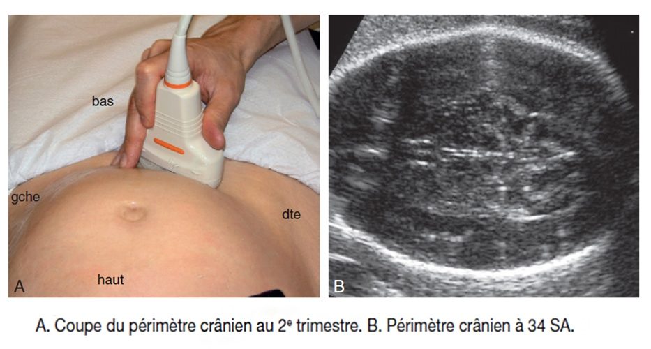 Périmètre crânien fœtal — biométrie échographique mesure PC