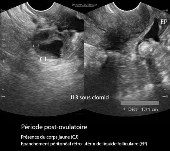 Période post-ovulatoire — phase lutéale cycle menstruel échographie
