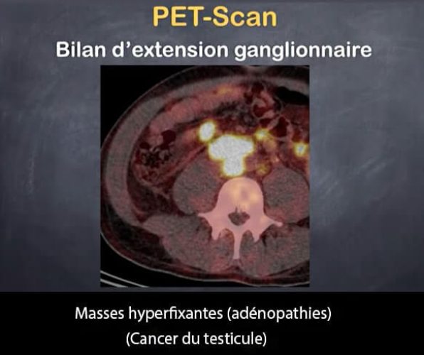 Pet scan