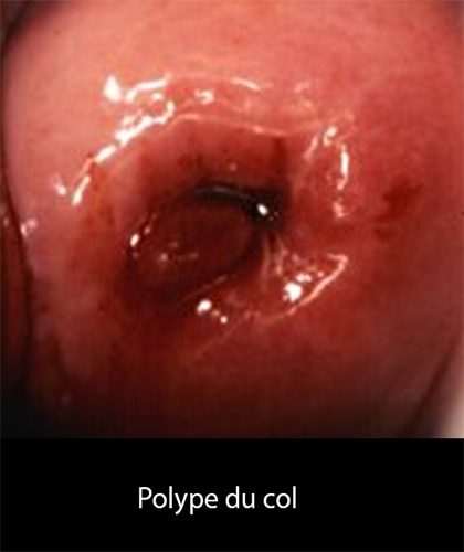 Polype du col 2