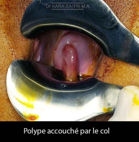 Polype du col 3