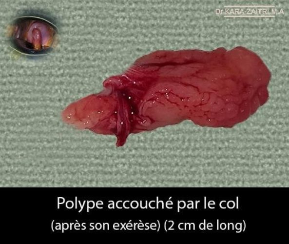 Polype du col 4