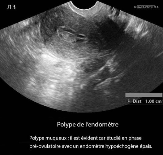 Polype endomètre