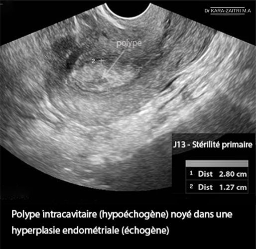 Polype intracavitaire — polype endométrial hystéroscopie 1