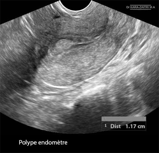 Polype intracavitaire — polype endométrial hystéroscopie 2
