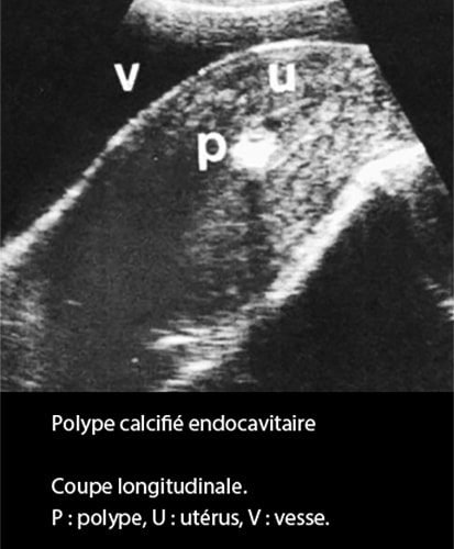 Polype intracavitaire — polype endométrial hystéroscopie 3