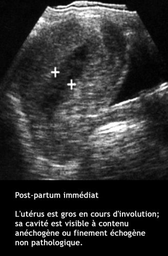 Post-partum — involution utérine et soins maternels 1