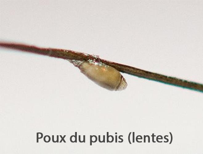 Pthirus pubis et lentes fixées sur tige pilaire — phtiriase pubienne