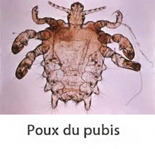 Pthirus pubis vu au microscope — morphologie du pou du pubis