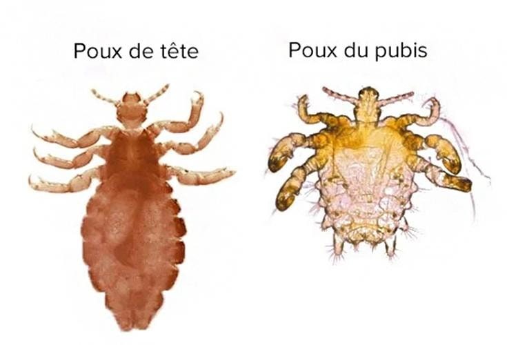 Comparaison morphologique pou de tête et pou du pubis Pthirus pubis