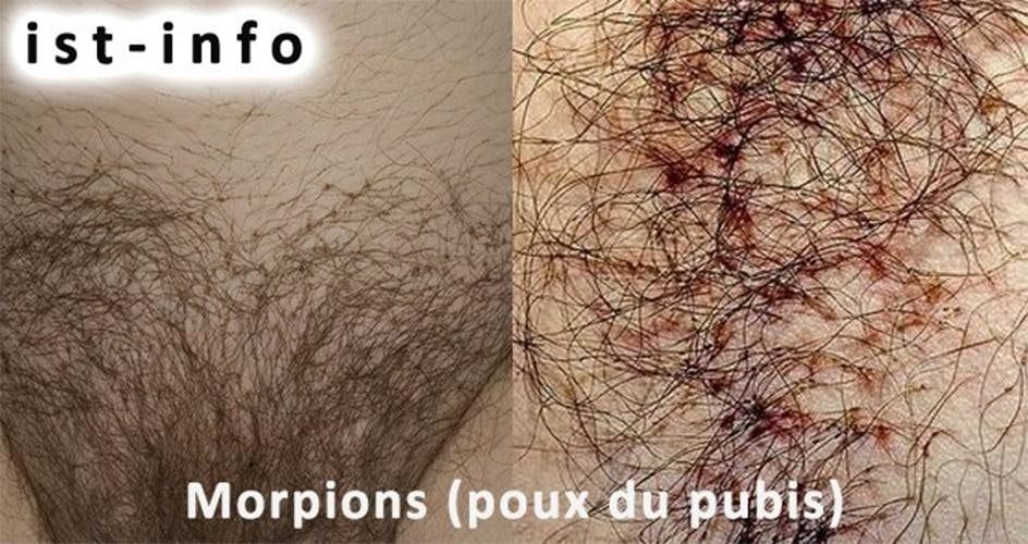 Morpions poux du pubis accrochés aux poils — phtiriase pubienne