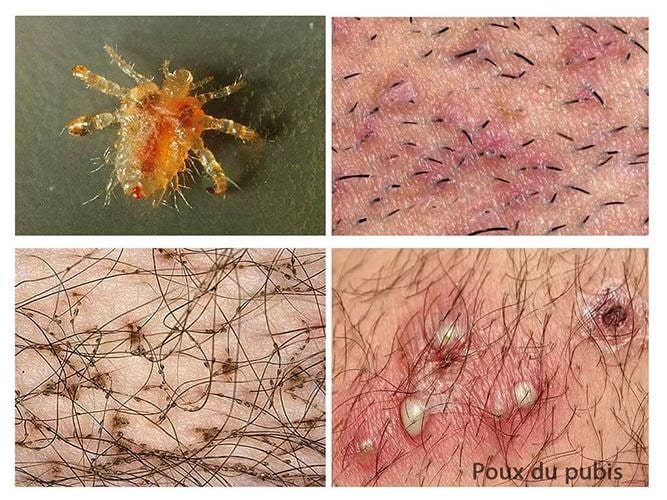 Lésions cutanées de phtiriase pubienne — macules bleutées et papules