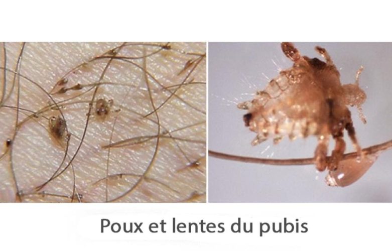 Poux du pubis et lentes accrochés aux poils pubiens — diagnostic phtiriase