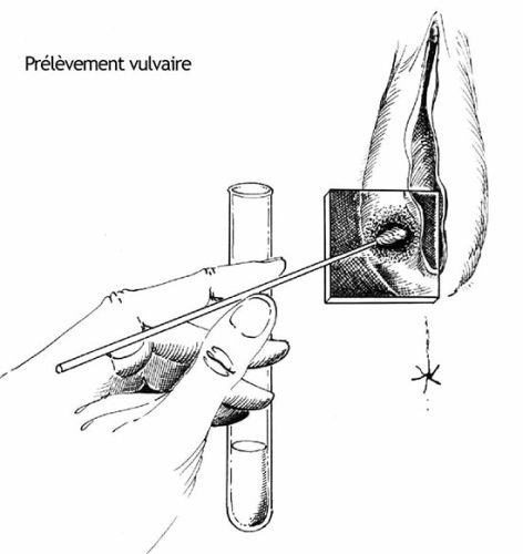 Prélèvement vulvaire — technique prélèvement microbiologique vulve