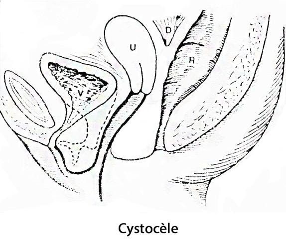 prolapsus génital