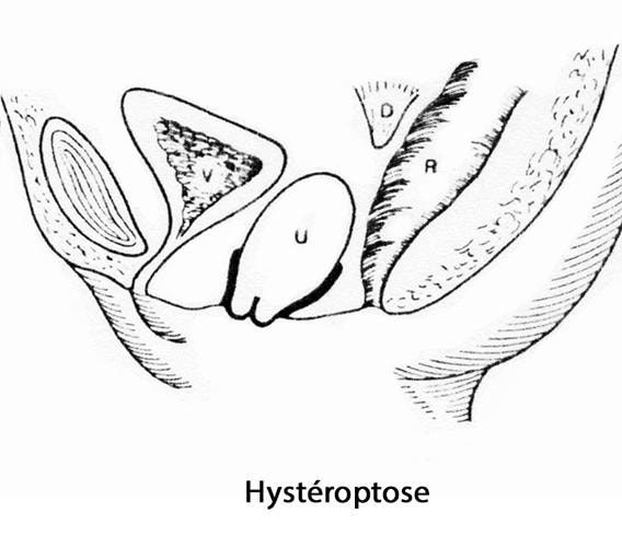 prolapsus génital