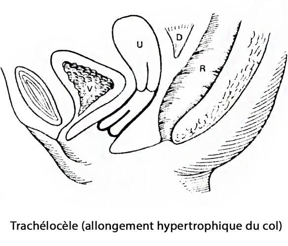 prolapsus génital