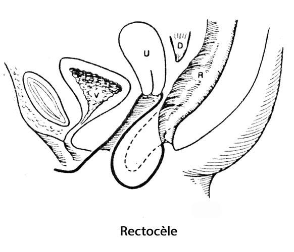 prolapsus génital