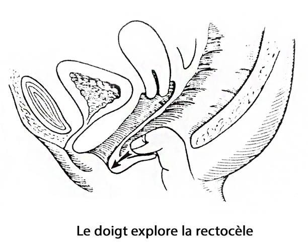 prolapsus génital