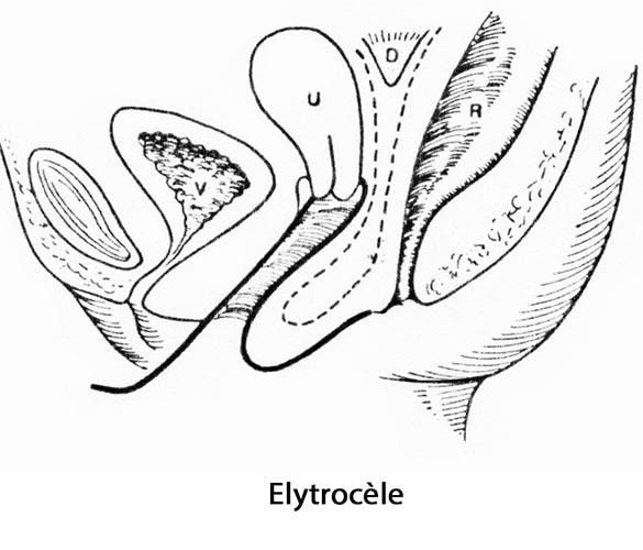 prolapsus génital