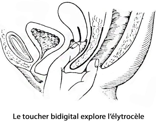 prolapsus génital