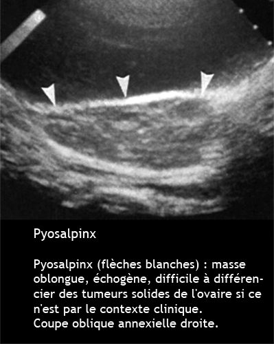 Pyosalpinx : échographie - Dr KARA-ZAITRI M.A