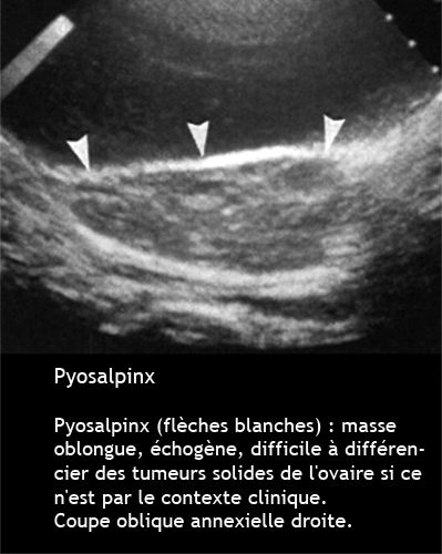Pyosalpinx 1