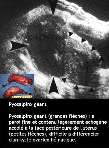 Pyosalpinx 2