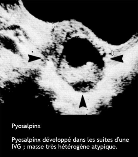 Pyosalpinx 3