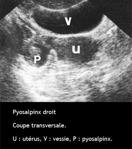 Pyosalpinx 4